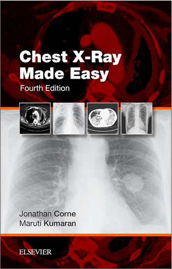 Chest X-Ray Made Easy 4th Edition
