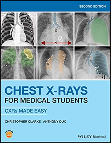Chest X-Rays for Medical Students 2nd Edition

