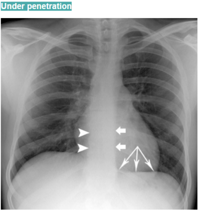 Chest X-Ray Quality: How to Interpret Chest X-Ray | CtsQena